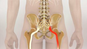 Bandscheibenvorfall oder Ischialgie